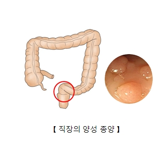 직장의 양성 종양