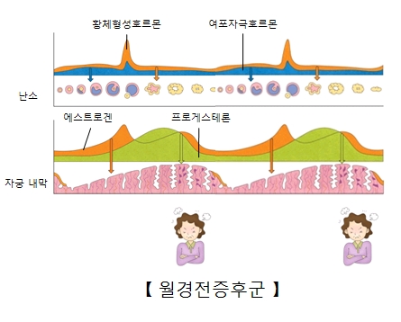 월경전증후군